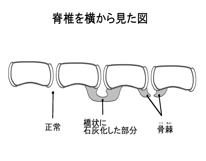 変形性脊椎症の模式図