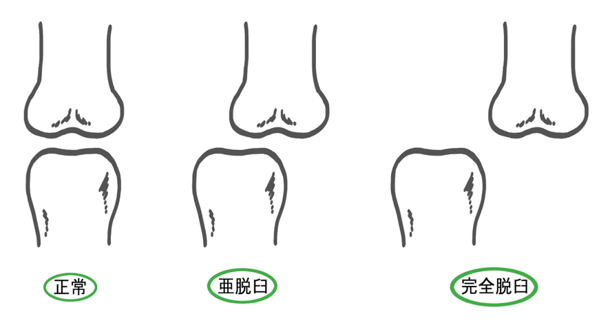 外傷性脱臼