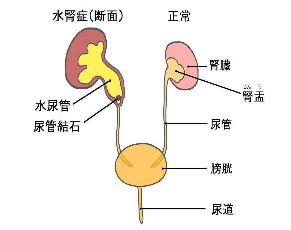 尿管結石による水腎症・水尿管、尿路の模式図