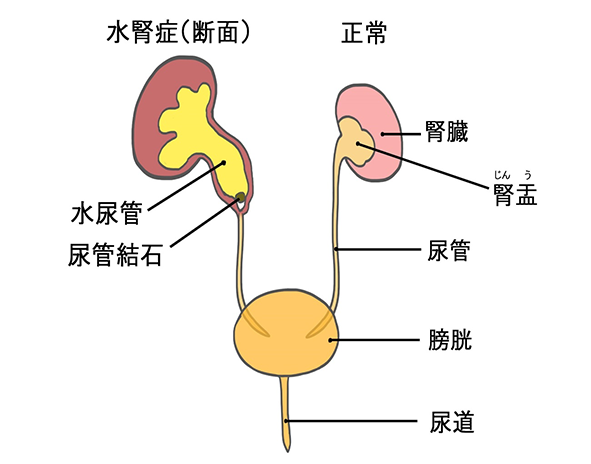 水腎症の模式図