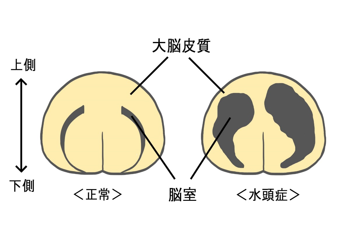 正常な脳と水頭症の脳の断面の模式図