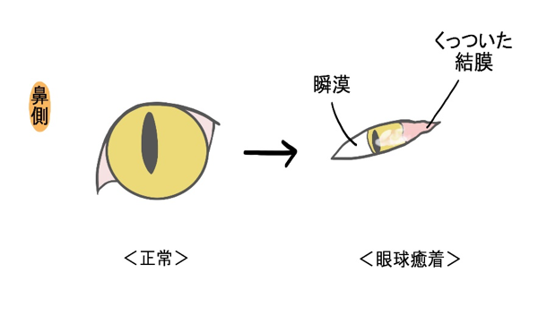 眼球癒着の外観的変化の一例