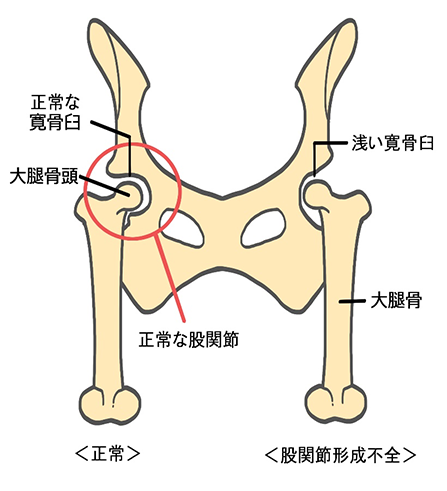 股関節形成不全の模式図