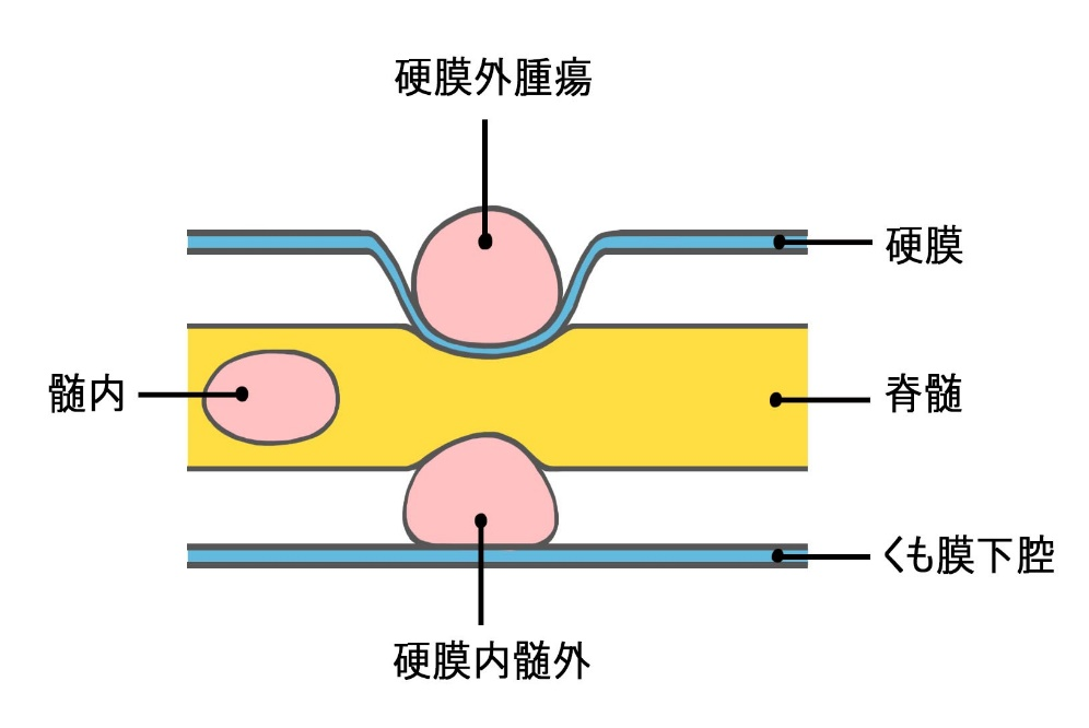 脊髄腫瘍の模式図
