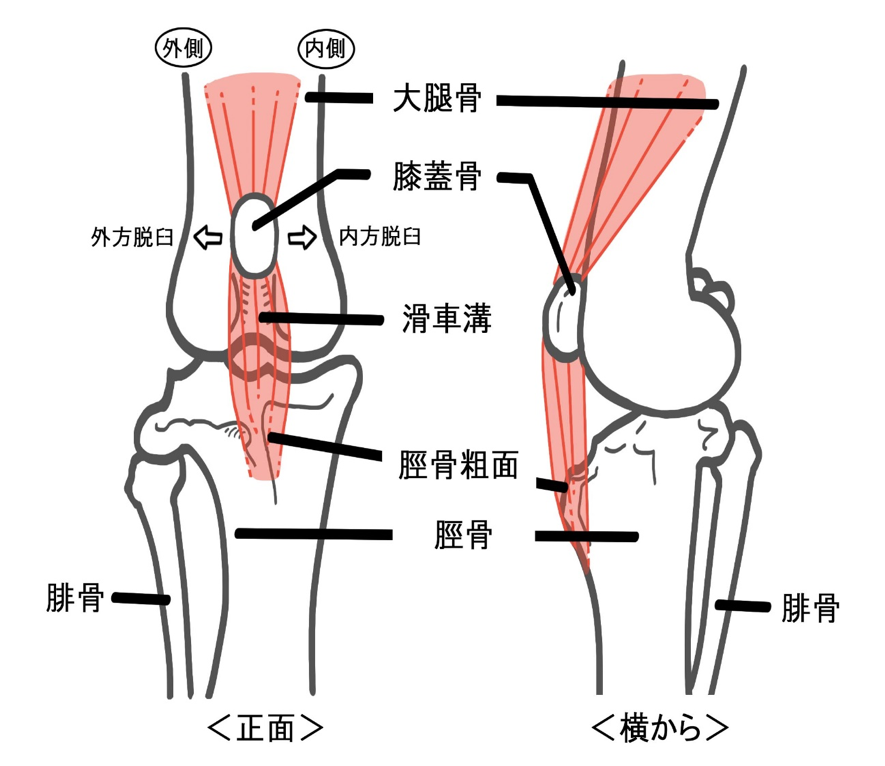 膝蓋骨脱臼