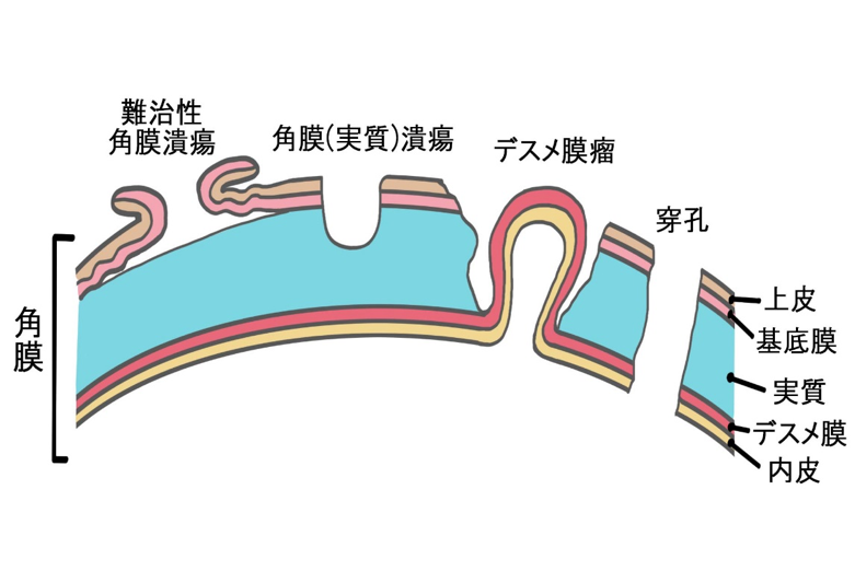 角膜潰瘍の種類