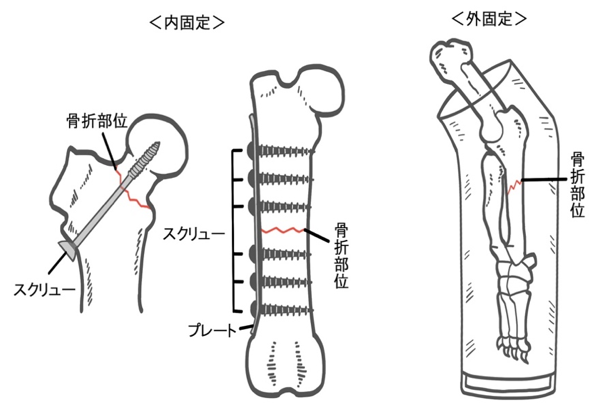 骨折